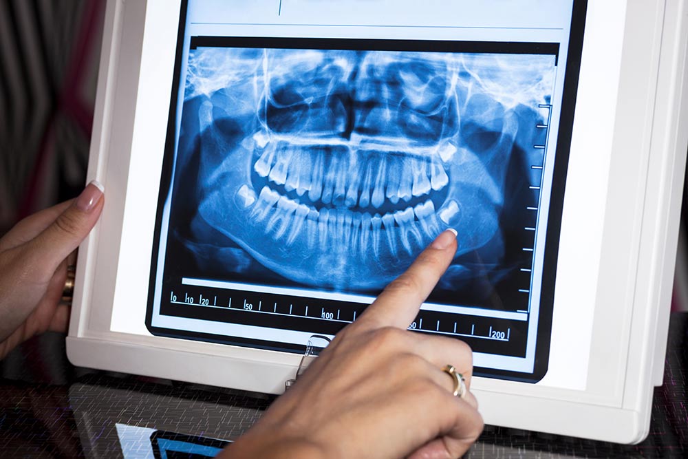 Digital X-rays - Preventative Dentistry in Sacramento - Ideal Dentistry