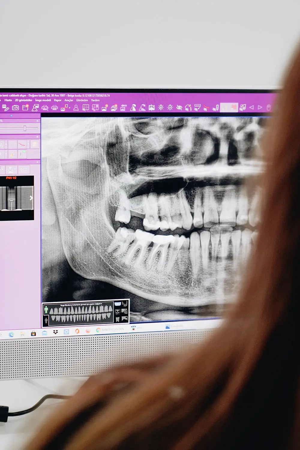 X-rays - Ideal Dentistry office visit